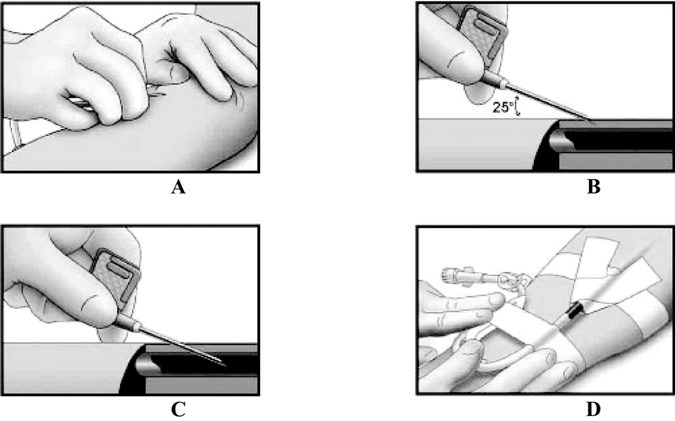 flipping the arterial vascular access needle