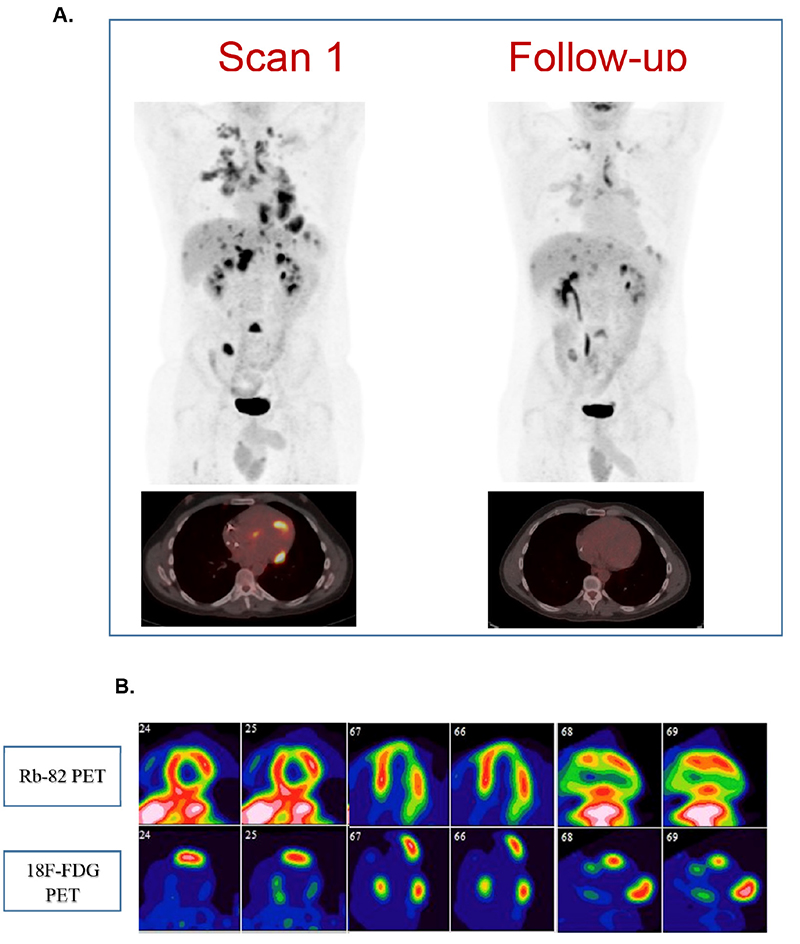 fluorodeoxyglucose positron emission tomography