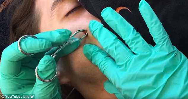 girl removing cyst from boyfriends face