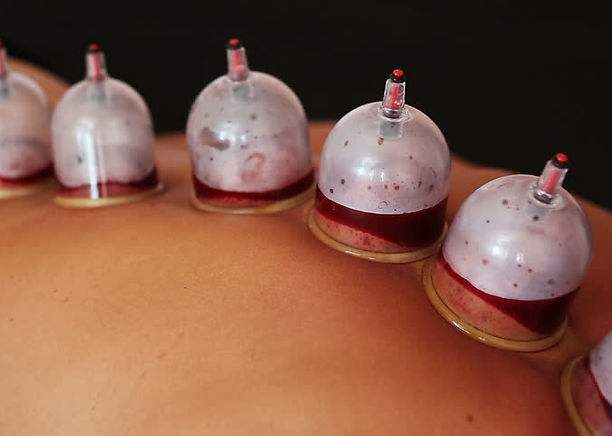 hijama near me