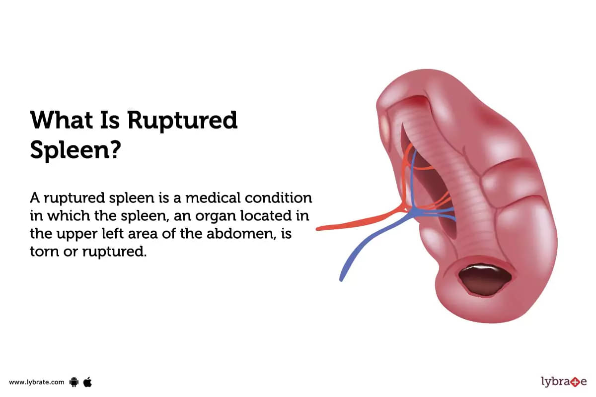 how long can you live with a ruptured spleen