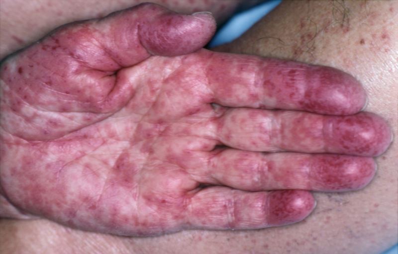 lamotrigine rash photos