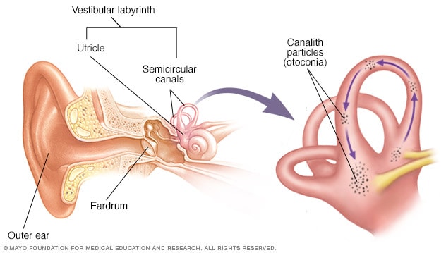 medical abbreviation bppv