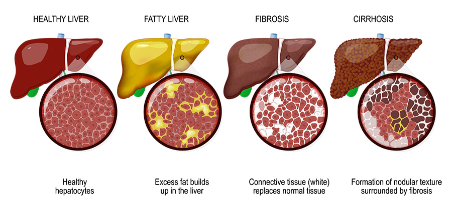 niacin liver damage myth