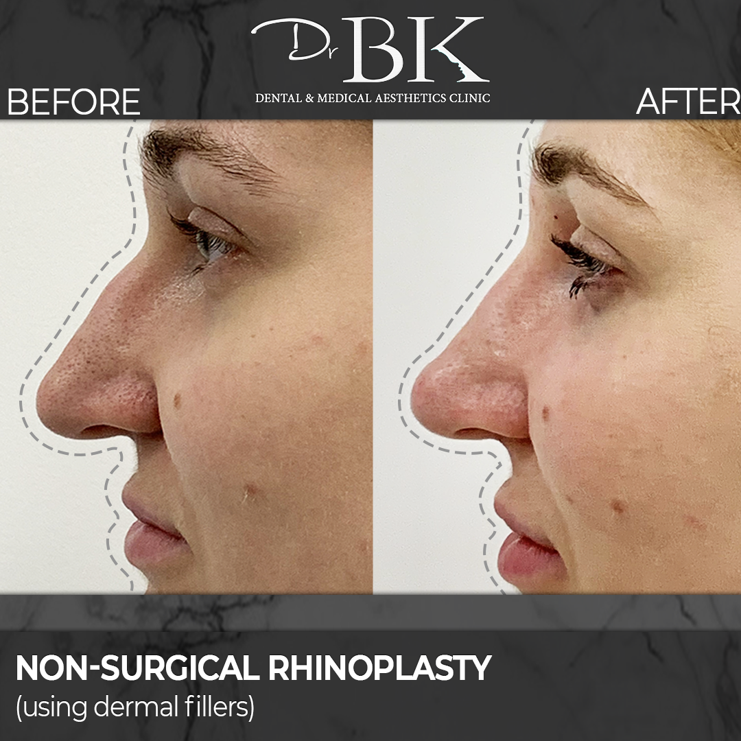 non surgical rhinoplasty leeds