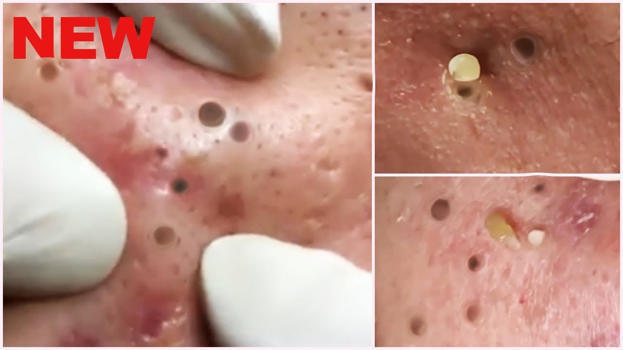 removing blackheads videos