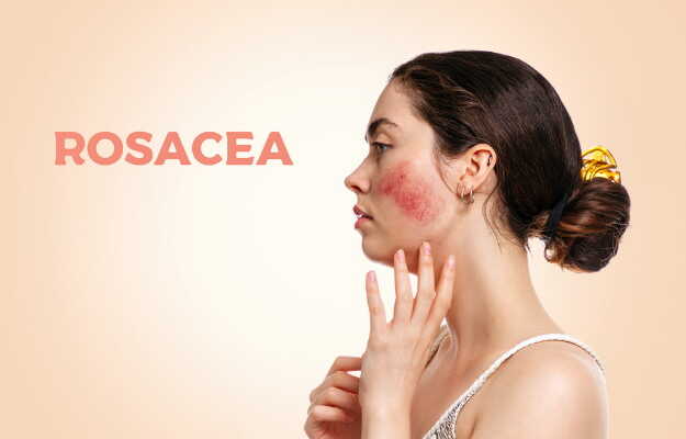 rosacea meaning in hindi