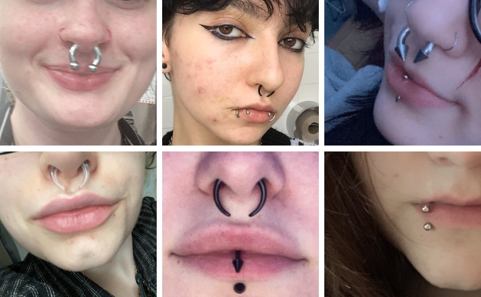 stretched septum