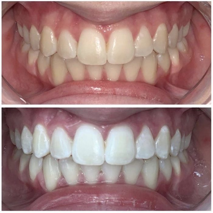 teeth bleaching doncaster east