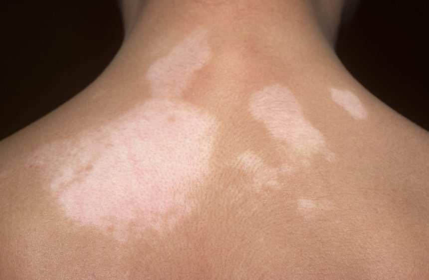 thyroid skin rash pictures face