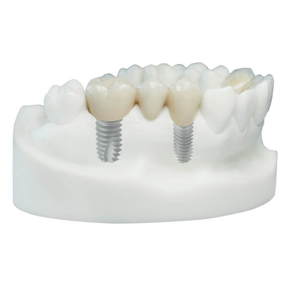 tooth implant mauritius