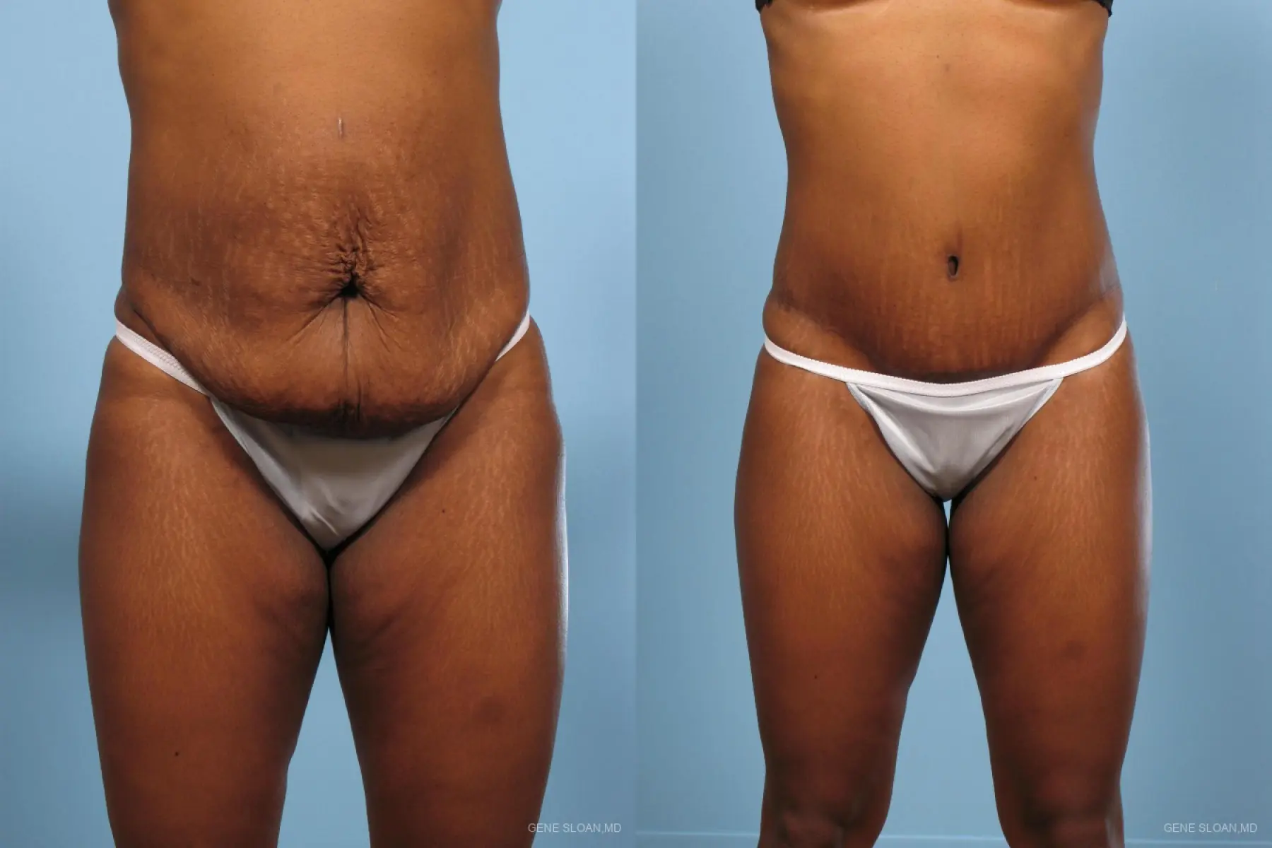 tummy tuck arkansas