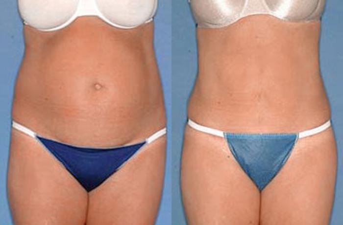 tummy tuck louisville ky