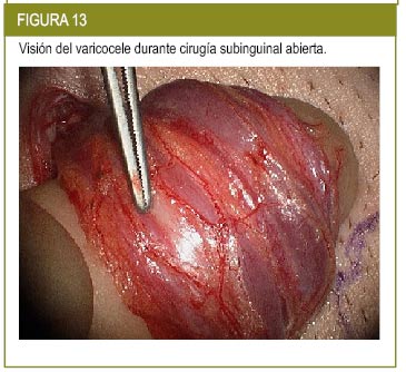 varicocele fotos reales